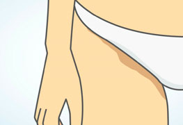 ilustração de região intima com manchas escuras ilustra clareamento intimo